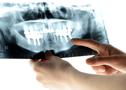 歯科で用いるレントゲン1｜いずみ中山歯科