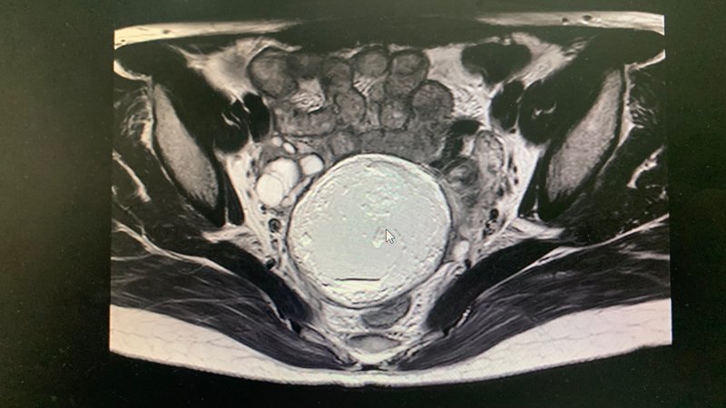 私の卵巣嚢腫【経験談】MRI画像／成熟嚢胞性奇形腫／皮様嚢腫