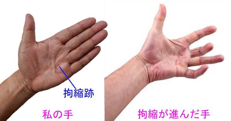 デュピュイトラン拘縮の原因は何ですか?誰が危険にさらされていますか?