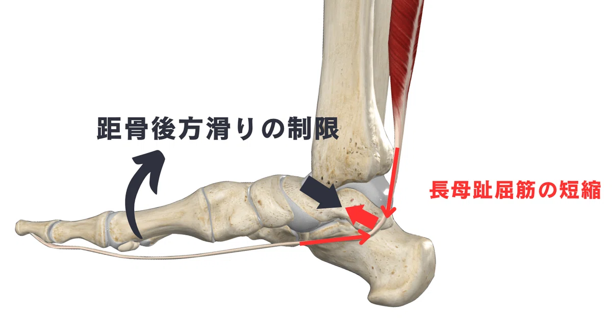  足関節背屈制限に対する選択的アプローチ｜理学療法士による臨床のためのnote Motiv 