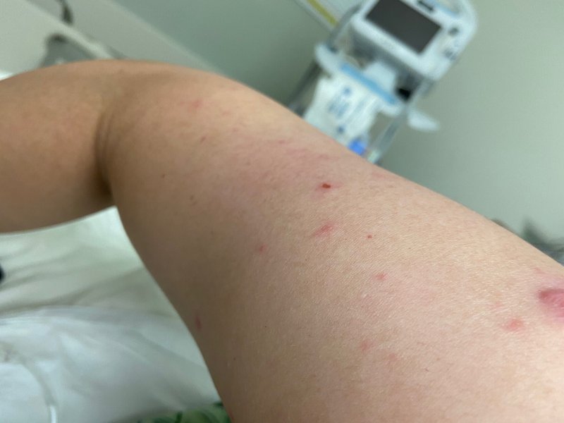 スティーブンス・ジョンソン症候群の写真