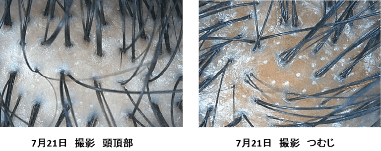 日焼けした頭皮のトリートメント