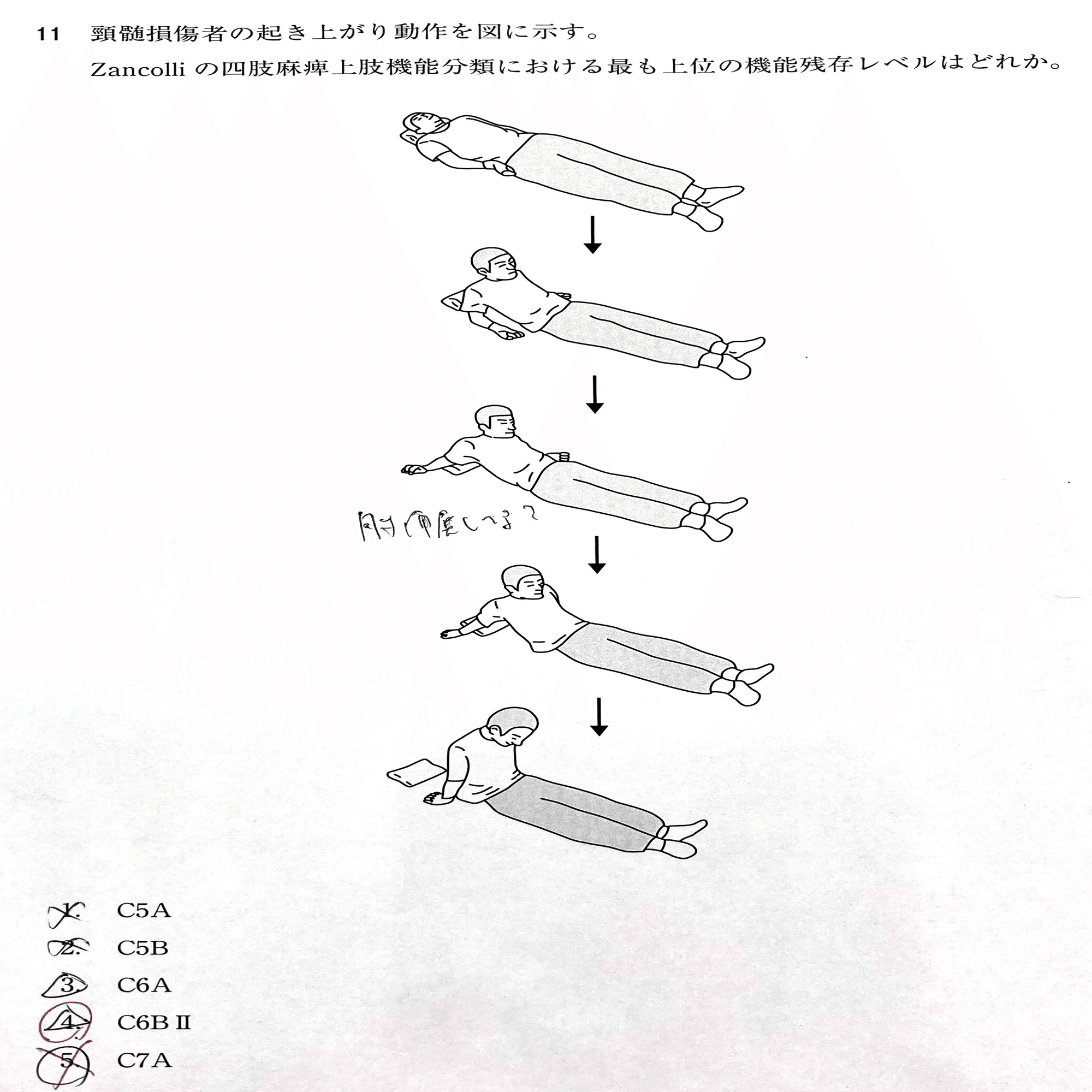 脊髄損傷】第58回理学療法士国家試験：午前11ー15【脳性麻痺】｜理学