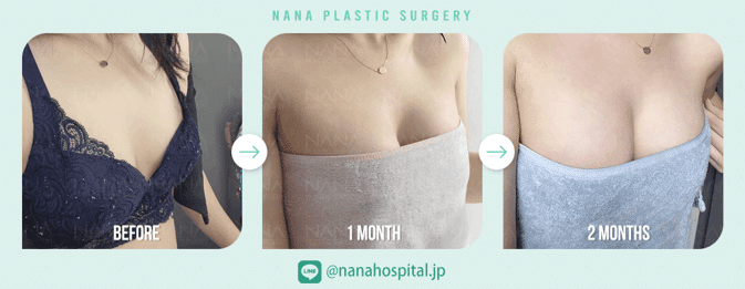 貧乳を美胸に‼豊胸手術について②｜韓国整形NANA美容外科