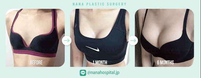 韓国整形　美容整形　NANA美容外科　シリコンバッグ　豊胸手術ビフォーアフター　症例写真