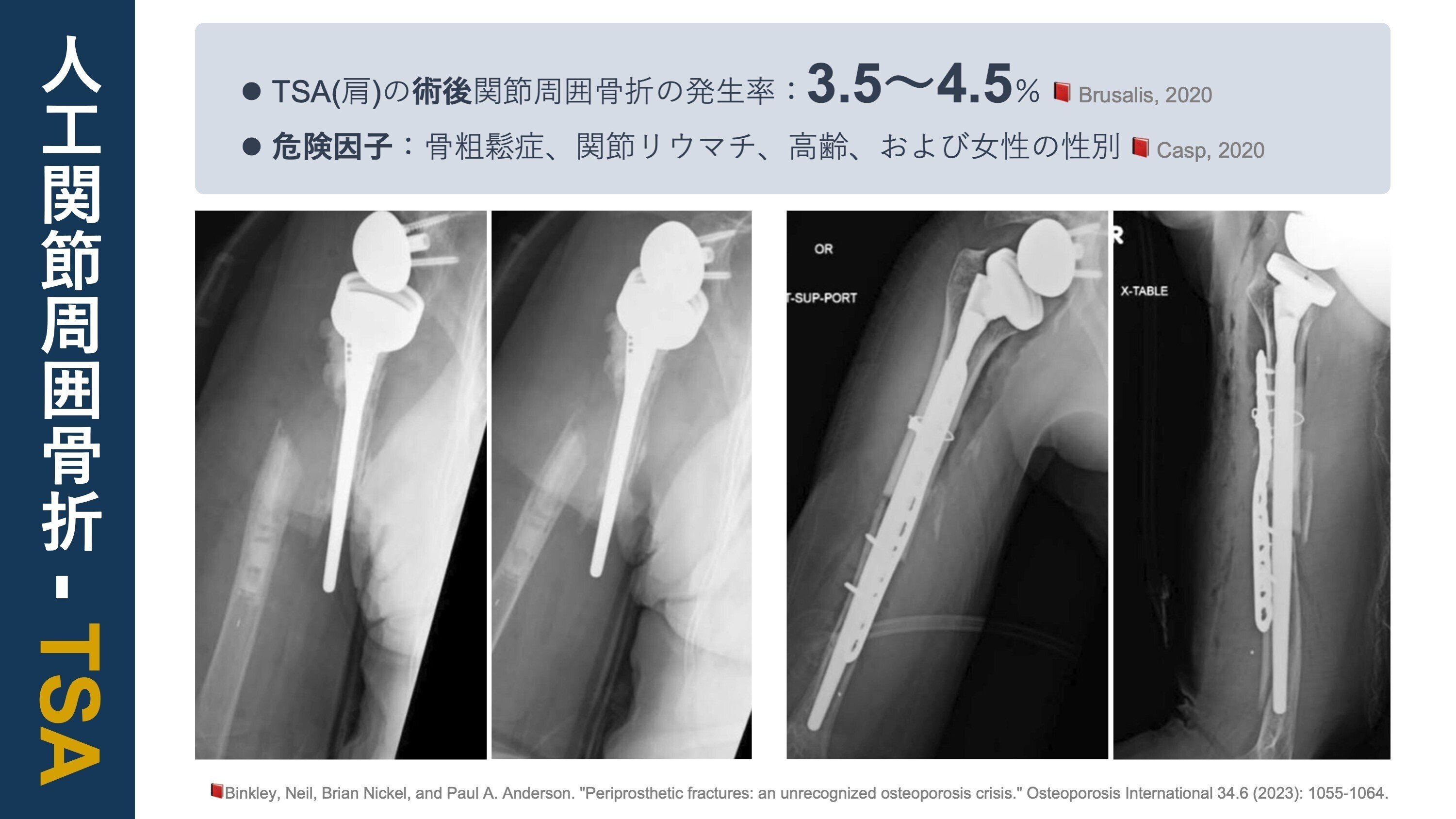 インプラント周囲骨折を極める - 本