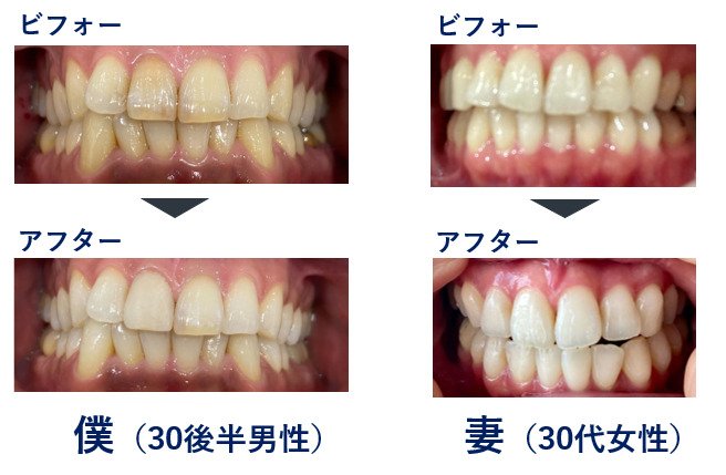 スターホワイトニングで3回施術した効果写真