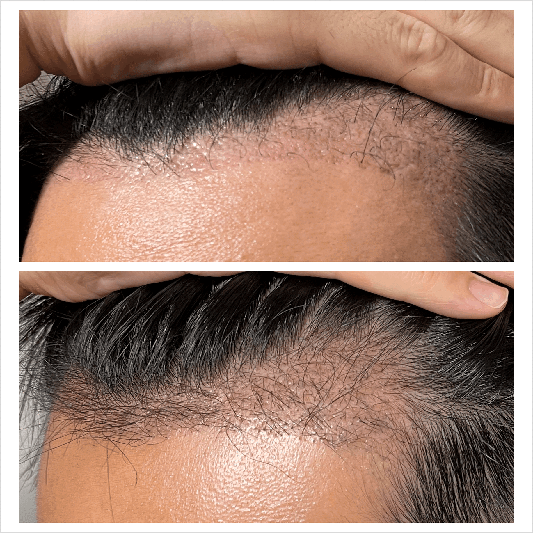 自毛植毛 体験レポート(※2024年8月更新）｜整形社員♂