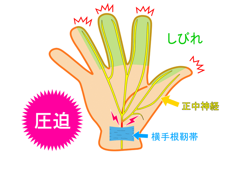 上肢における絞扼性末梢神経障害の評価と治療～神経系