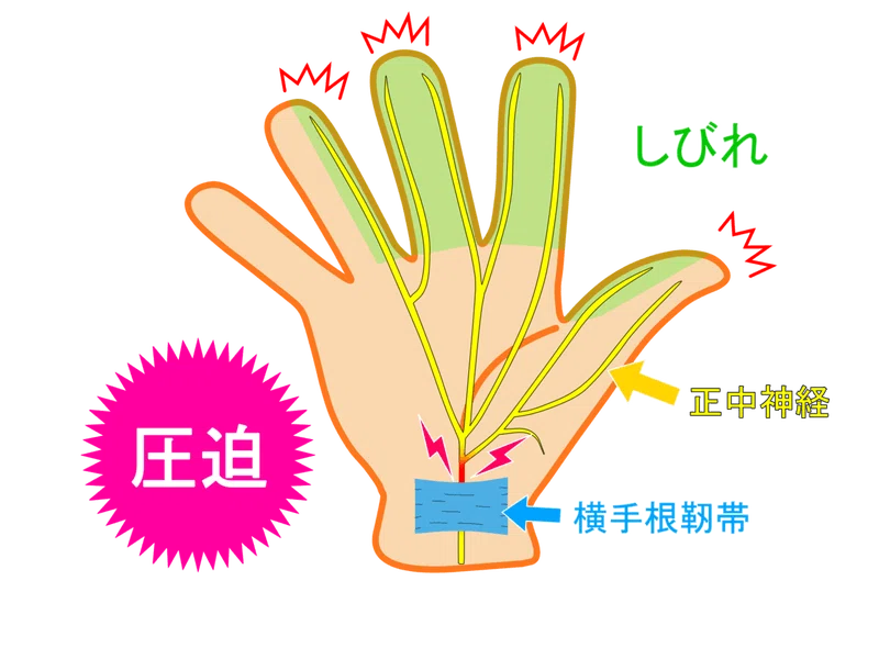 上肢絞扼性神経障害の評価と臨床応用|理学療法士による臨床の 上肢絞扼性神経障害の評価と臨床応用|理学療法士による臨床の