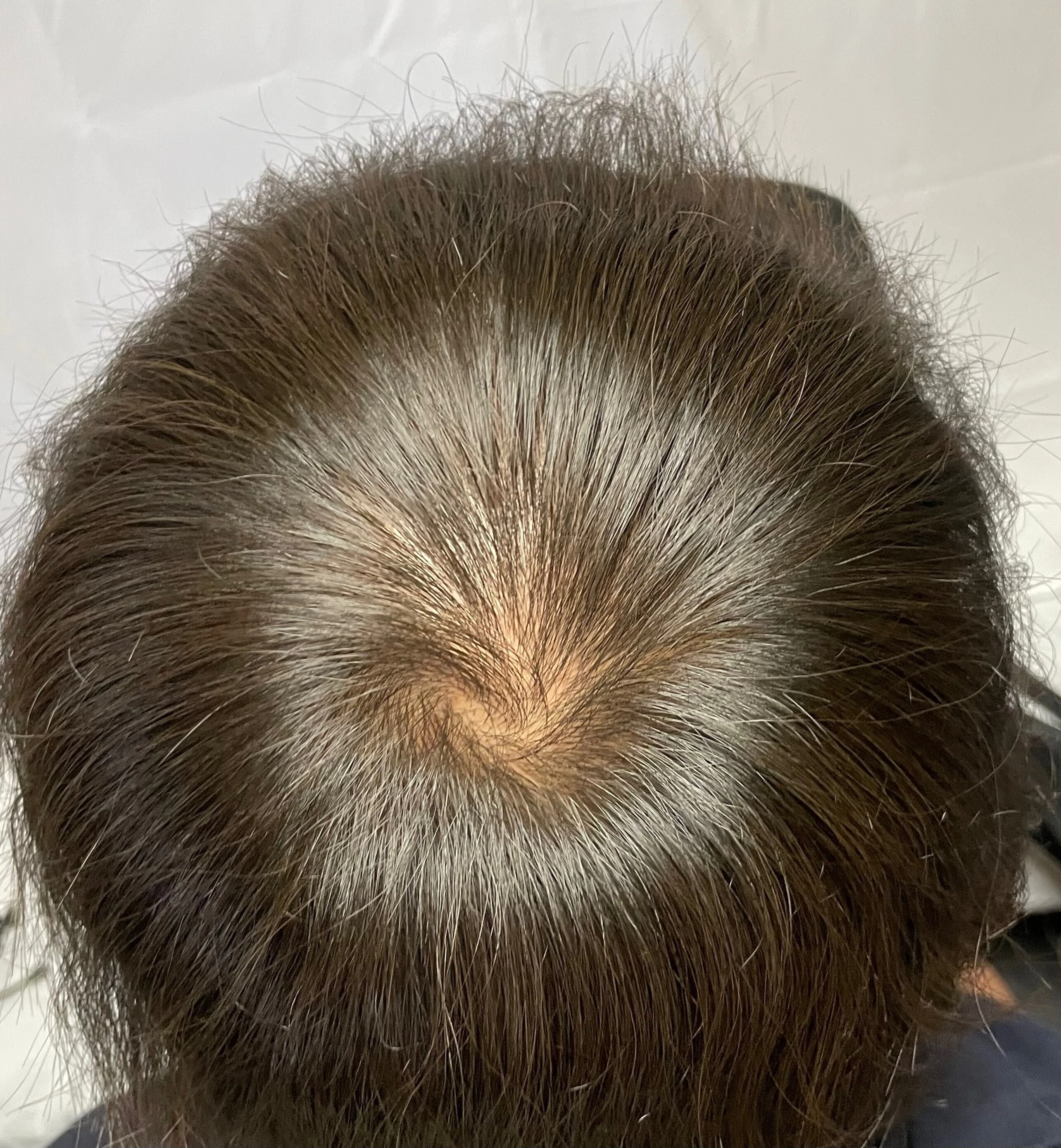 若年性M字ハゲ 若ハゲのための邪道ヘアセット（前編）！！全スカM字ハゲ必見！！｜ぶる