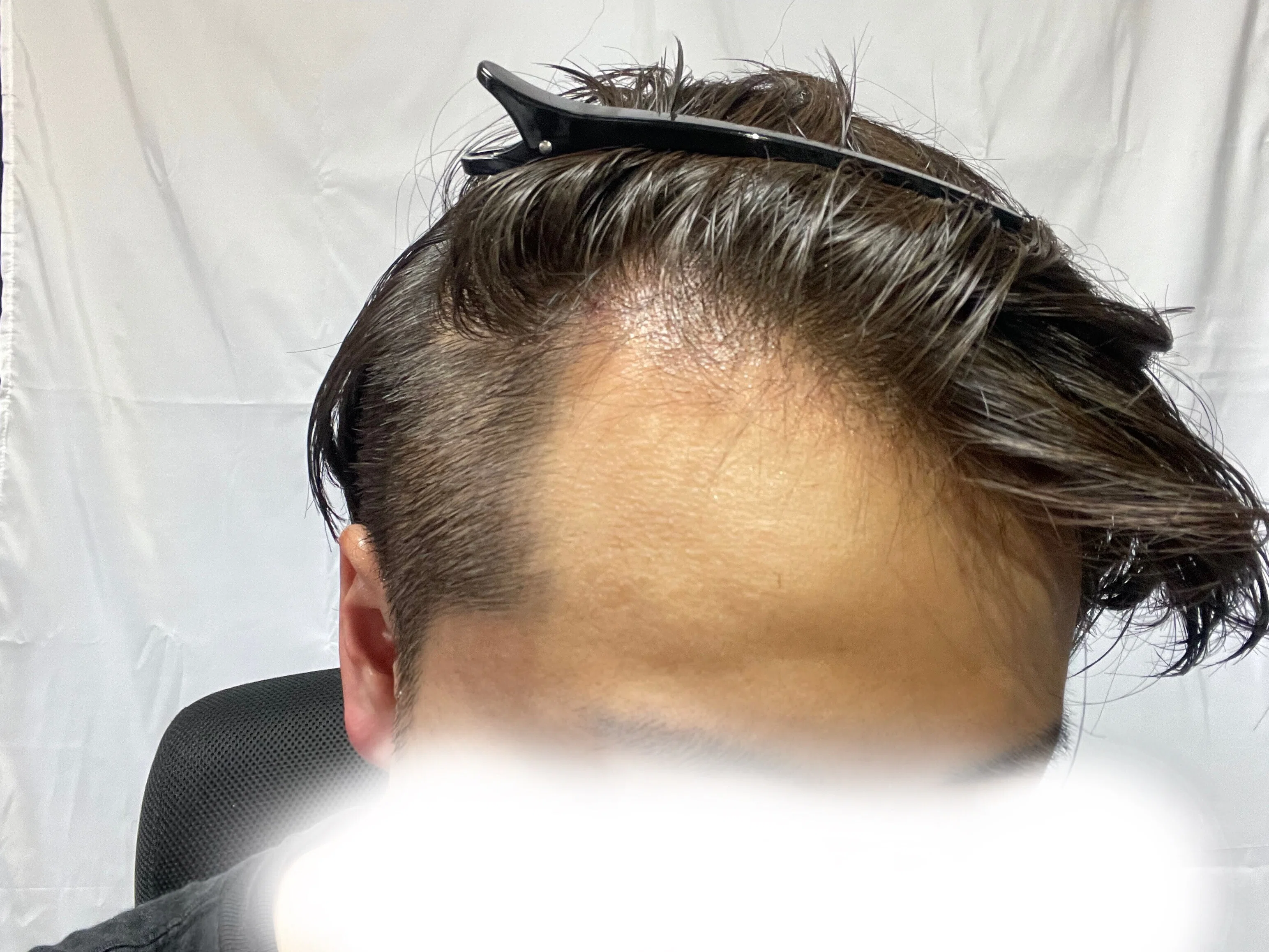 若ハゲのための邪道ヘアセット（前編）！！全スカM字ハゲ必見！！｜ぶる