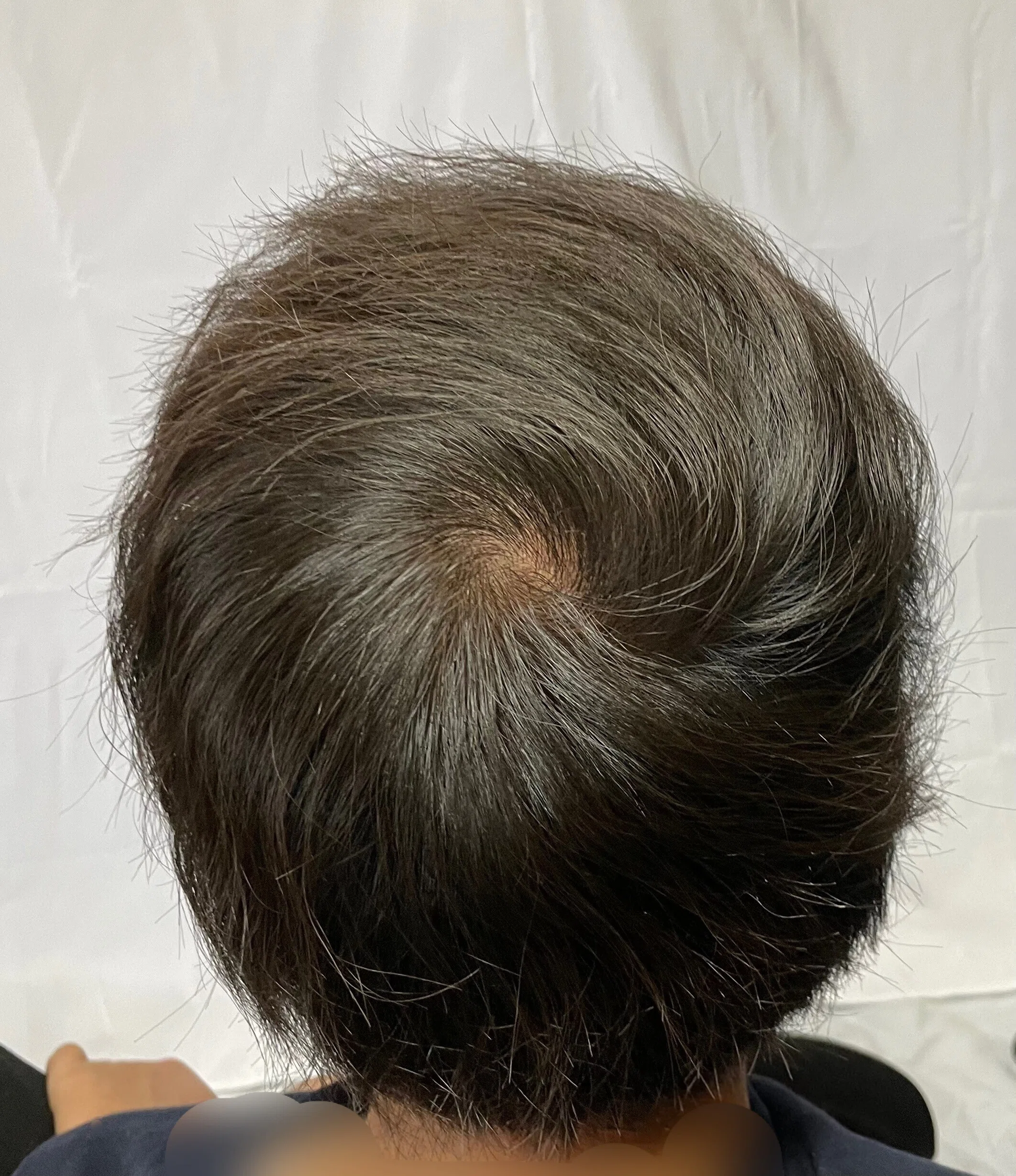 若ハゲのための邪道ヘアセット（前編）！！全スカM字ハゲ必見！！｜ぶる