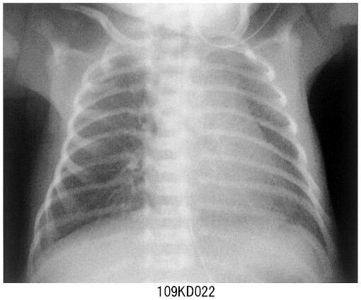 一過性の頻呼吸はどのようにして防ぐことができるのでしょうか?
