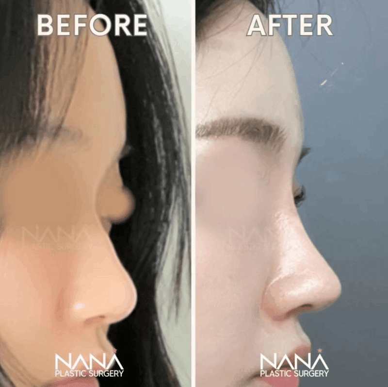 韓国整形　NANA美容外科　鼻整形　鼻尖形成　症例　鼻　おすすめ