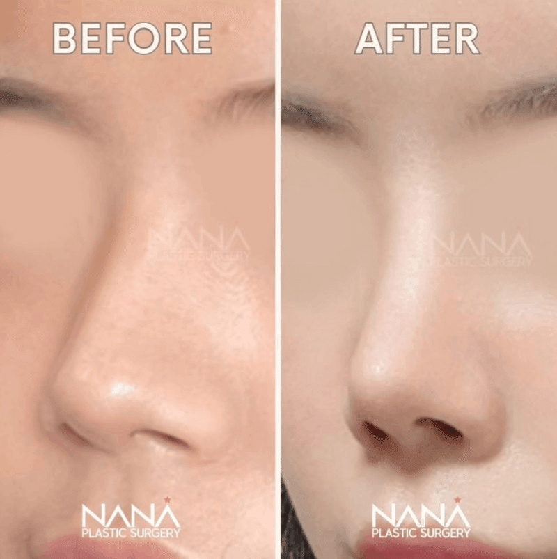 韓国整形　NANA美容外科　鼻整形　鼻尖形成　症例　鼻　おすすめ