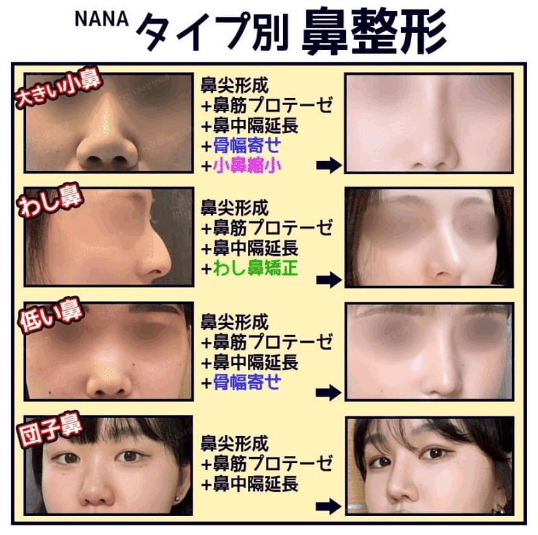 韓国整形 NANA美容外科　鷲鼻　小鼻　低い鼻　団子鼻　解消