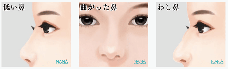 韓国整形　NANA美容外科　韓国鼻整形　鼻尖形成　小鼻縮小
