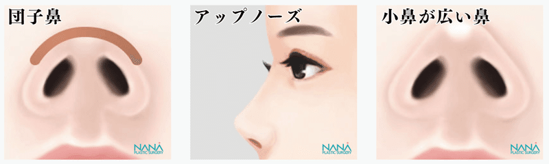 韓国整形　NANA美容外科　韓国鼻整形　鼻尖形成　小鼻縮小韓国整形　NANA美容外科　韓国鼻整形　鼻尖形成　団子鼻　鷲鼻矯正