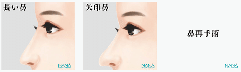 韓国整形　NANA美容外科　存在感のない鼻
