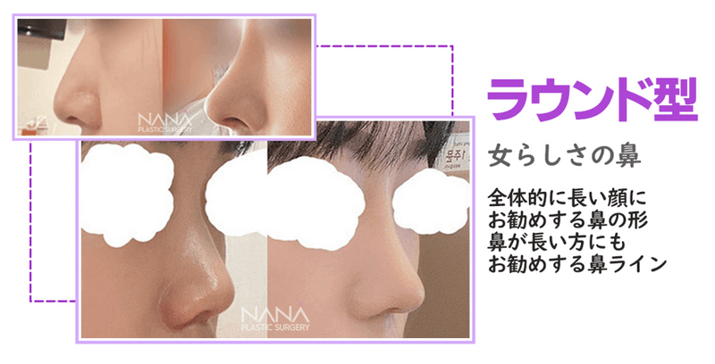 韓国整形　NANA美容外科　鼻整形　ラウンド鼻　スリム　高鼻