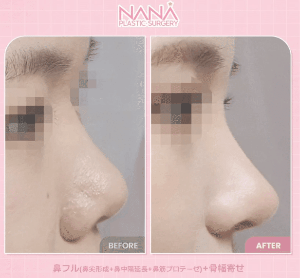 韓国整形　NANA美容外科　鼻整形　鼻尖形成　症例　鼻　おすすめ　DT　ダウンタイム