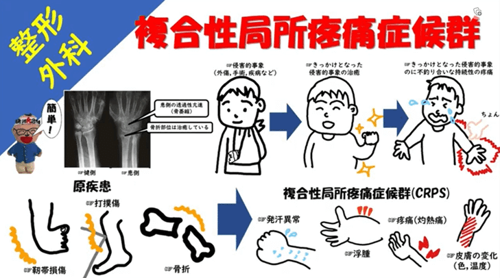 複合性局所疼痛症候群(CRPS)｜令和リハ国試塾