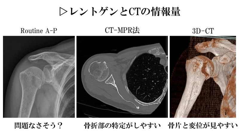 美品第3版 肩関節のMRI−読影ポイントのすべて 肩関節