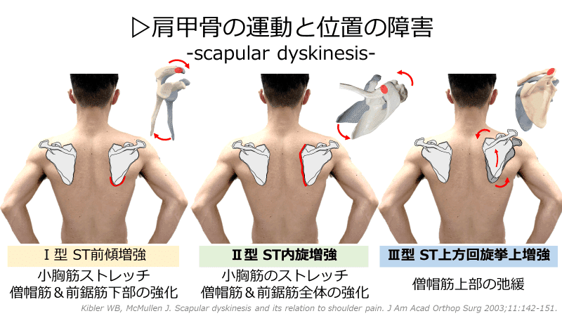 全身運動からみる肩関節の評価 ～肩関節疾患のメカニズムと評価