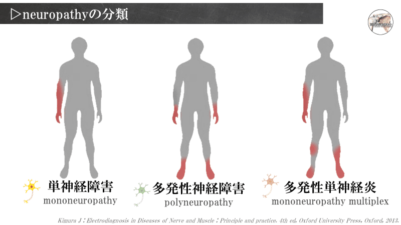 多発性神経障害のある人の平均余命はどれくらいですか?