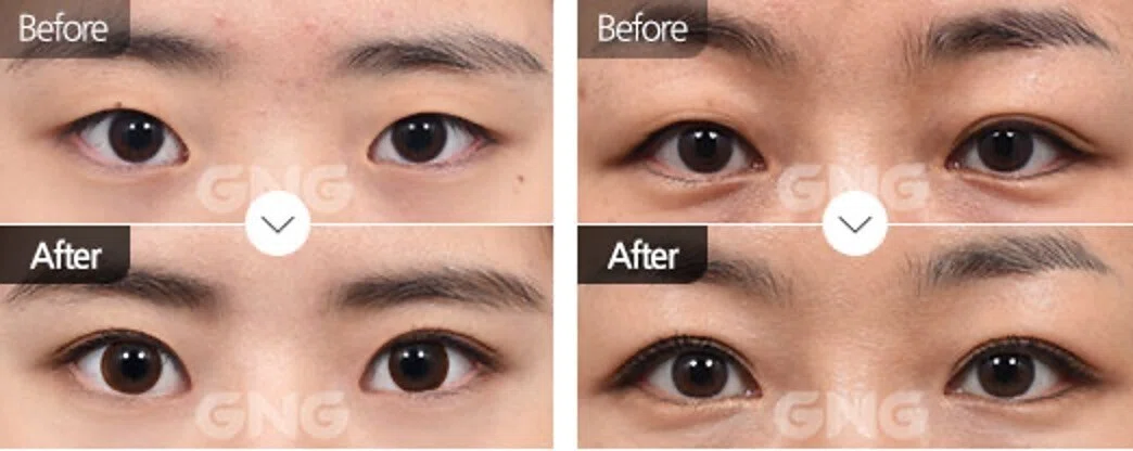 Crusifix Incision GNG's Double Cross Buried Suture Method!|韓国GNG病院 美容外科