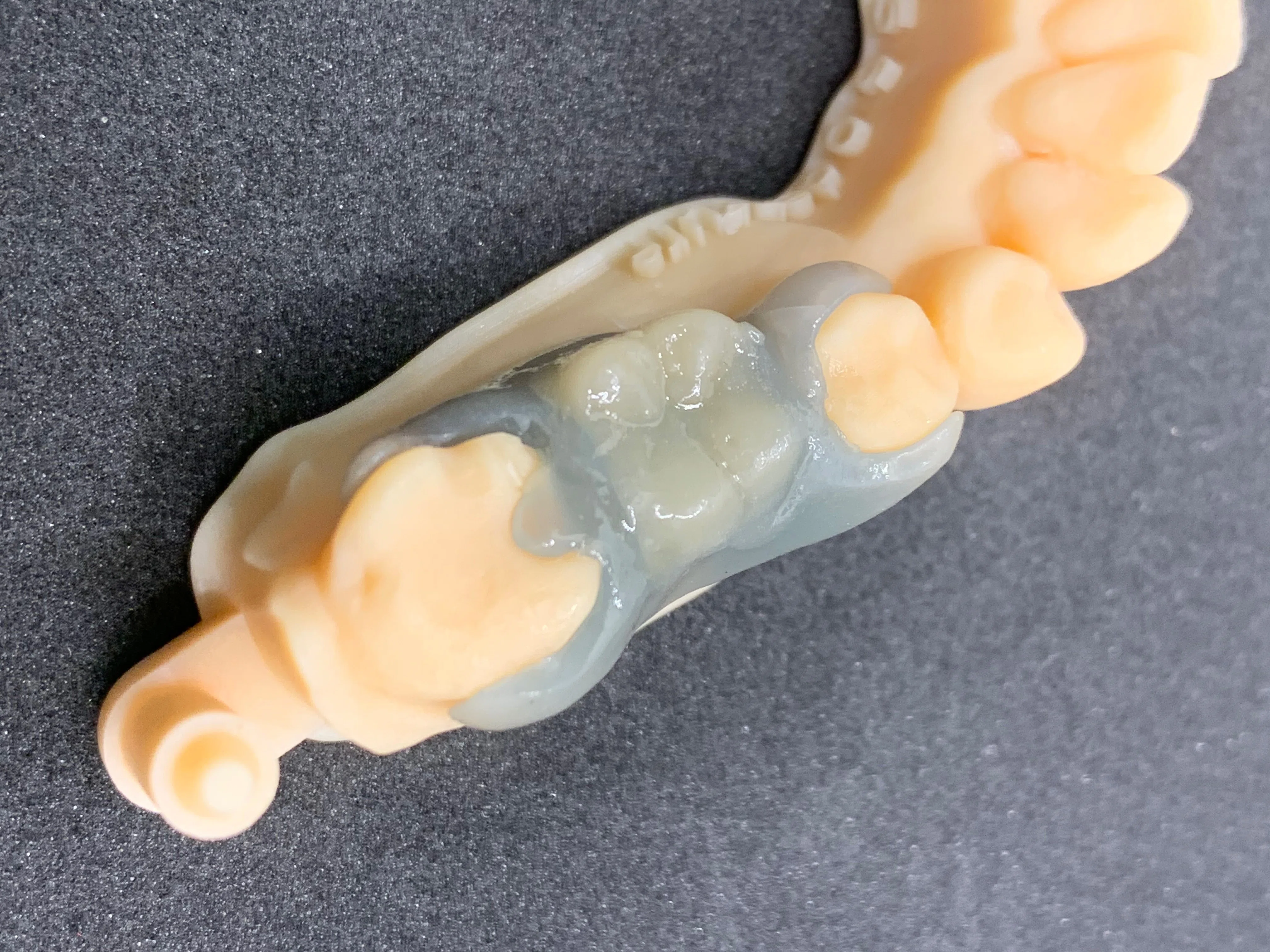Medit SplintとMedit Designを使用したパーシャルデンチャー作成の方法