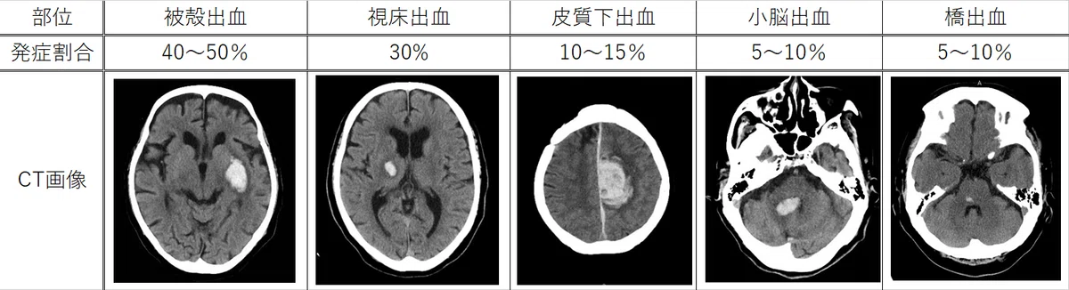 脳出血 #7-1｜脳卒中リハビリテーション看護認定看護師の脳の中