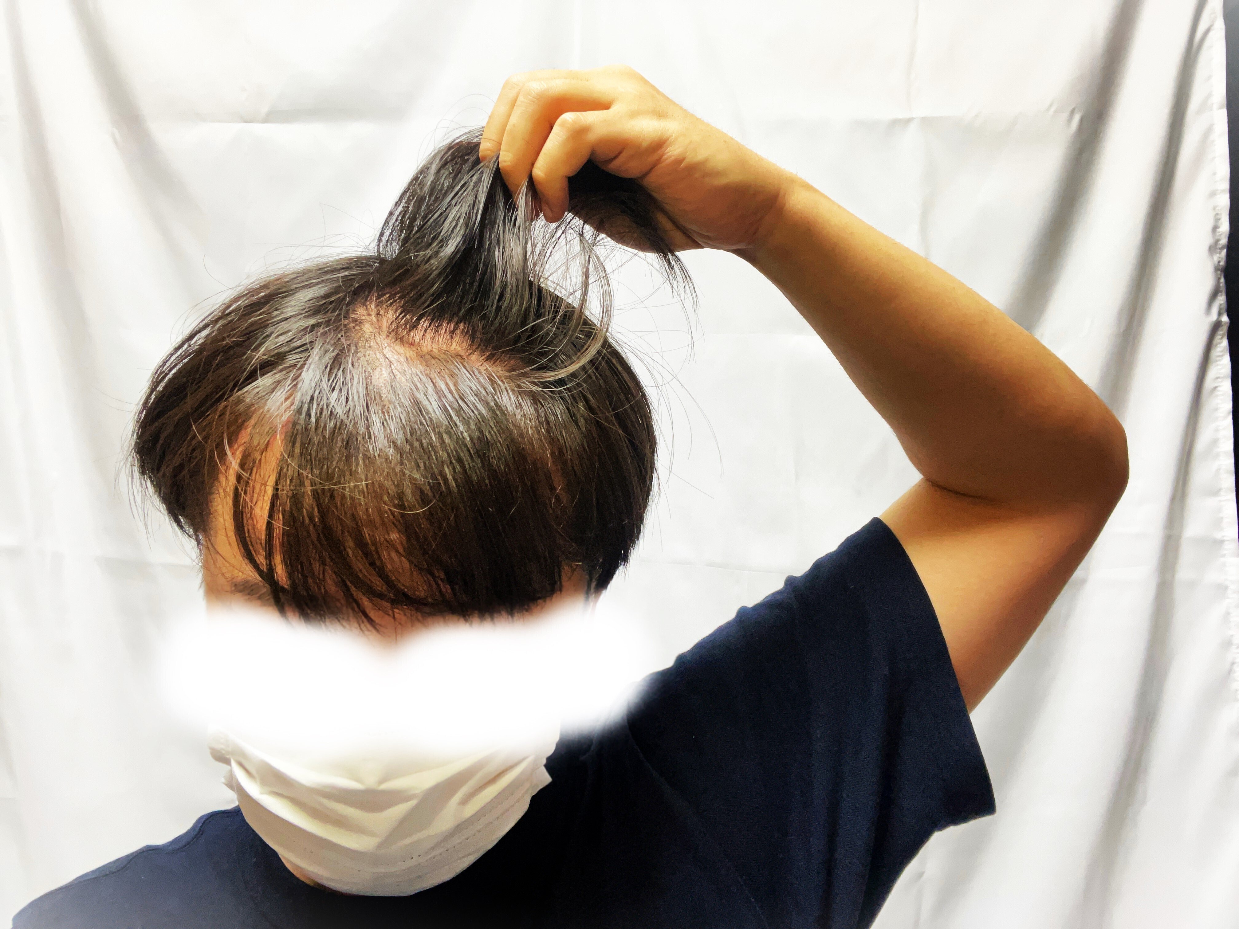 若ハゲのための邪道ヘアセット（前編）！！全スカM字ハゲ必見！！｜ぶる