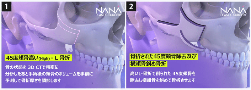 韓国整形 NANA美容外科　頬骨縮小　小顔整形　頬骨張り　韓国美容整形　顔面輪郭手術　固定ピン