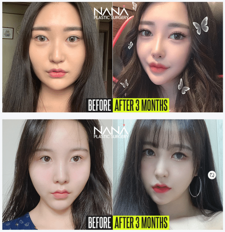 韓国整形 NANA美容外科　頬骨縮小　小顔整形　頬骨張り　症例写真