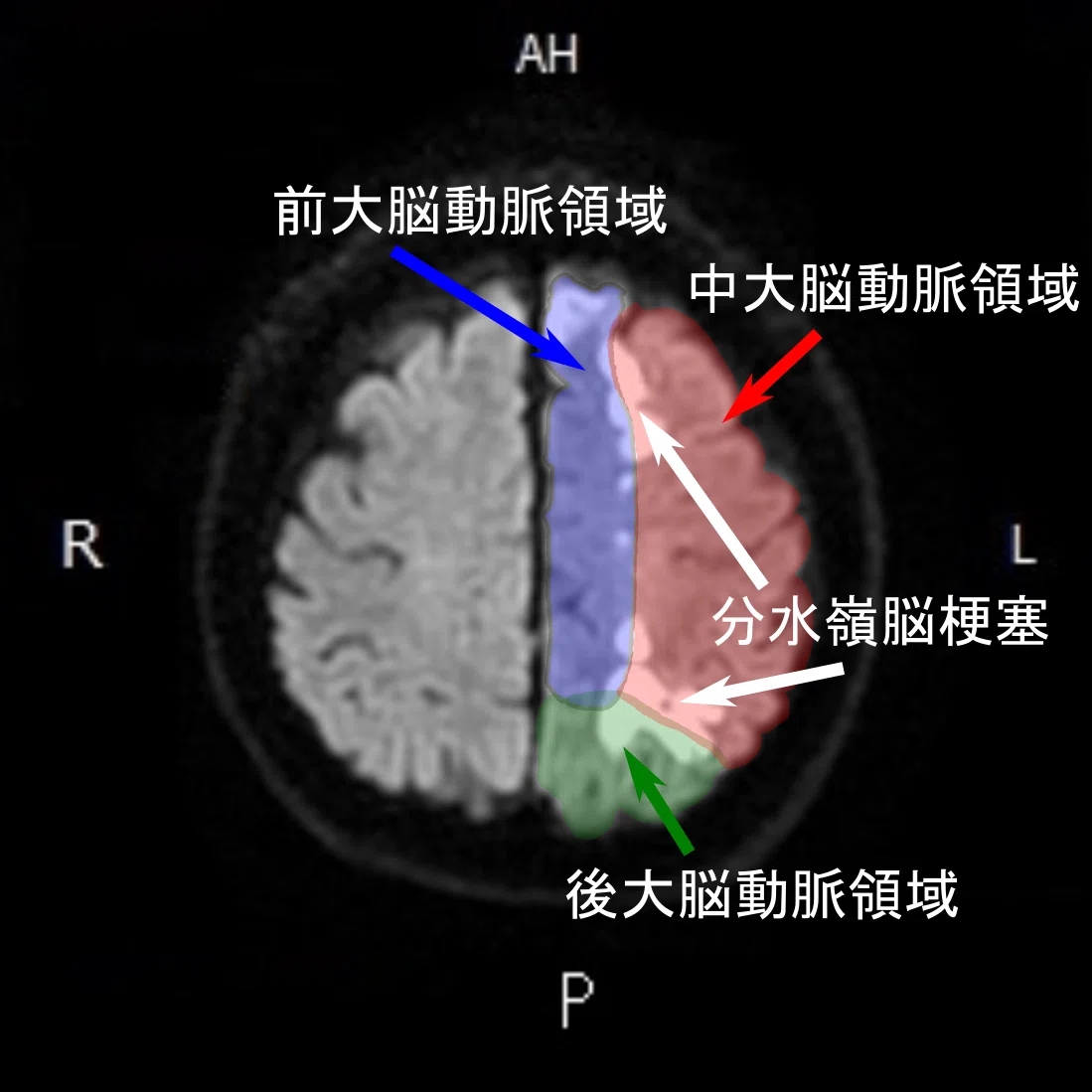 Mca Pca分水嶺脳梗塞 _ 分水嶺脳梗塞 分類 : early CT signの画像診断は?CTで脳梗塞を診断する! – MEKK