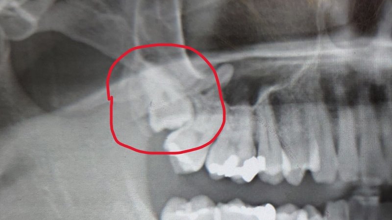 抜歯前の右上埋伏智歯の状態画像