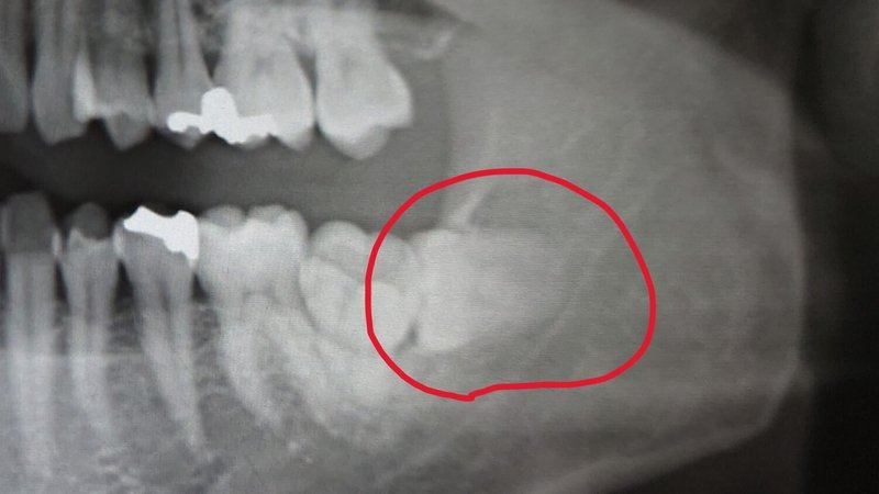 抜歯前の左下埋伏智歯の状態画像