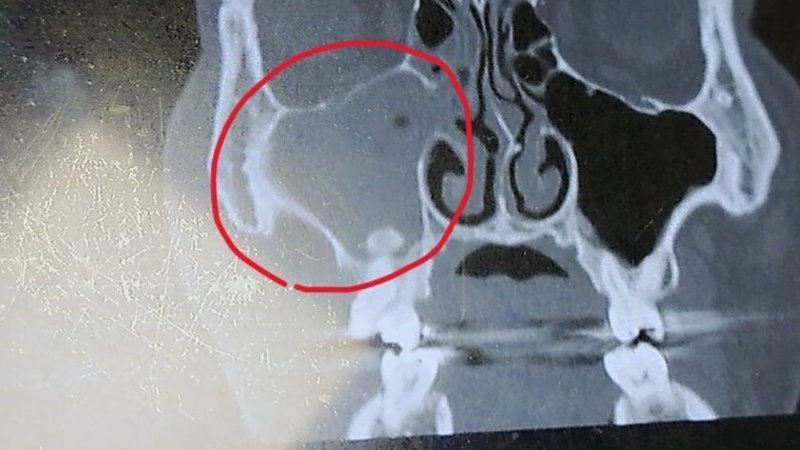 上顎洞炎の発症（CTスキャン画像）