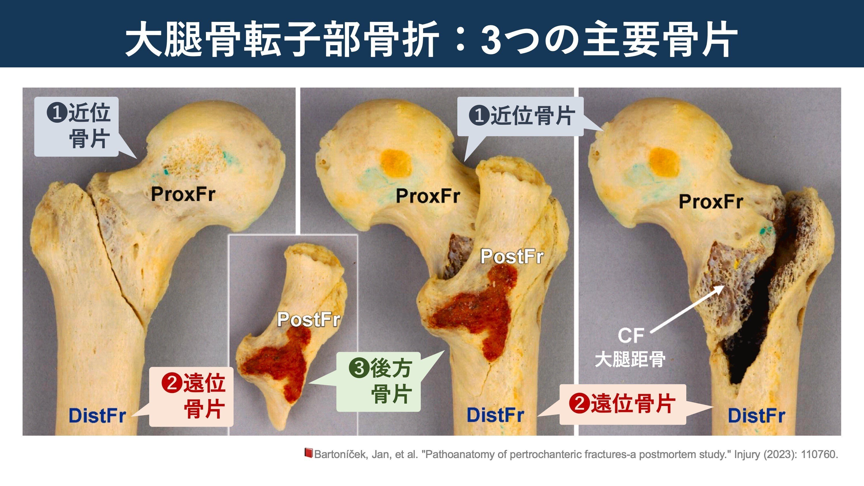 【裁断済み】大腿骨近位部骨折 : 大腿骨頚部・転子部・転子下骨折の手術手技 大腿骨近位部骨折：大腿骨頚部・転子部・転子下骨折の手術手技