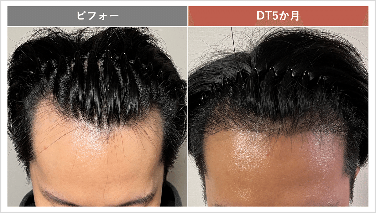 Dr.今川の植毛体験記 専門医が自分の髪で実践したドキュメント 最先端の自毛植… Amazon.co.jp: 今川 賢一郎: 本