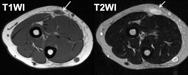 結節性筋膜炎の原因