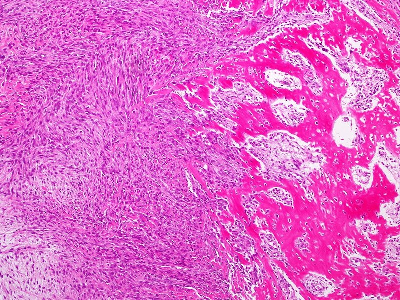 結節性筋膜炎の症状
