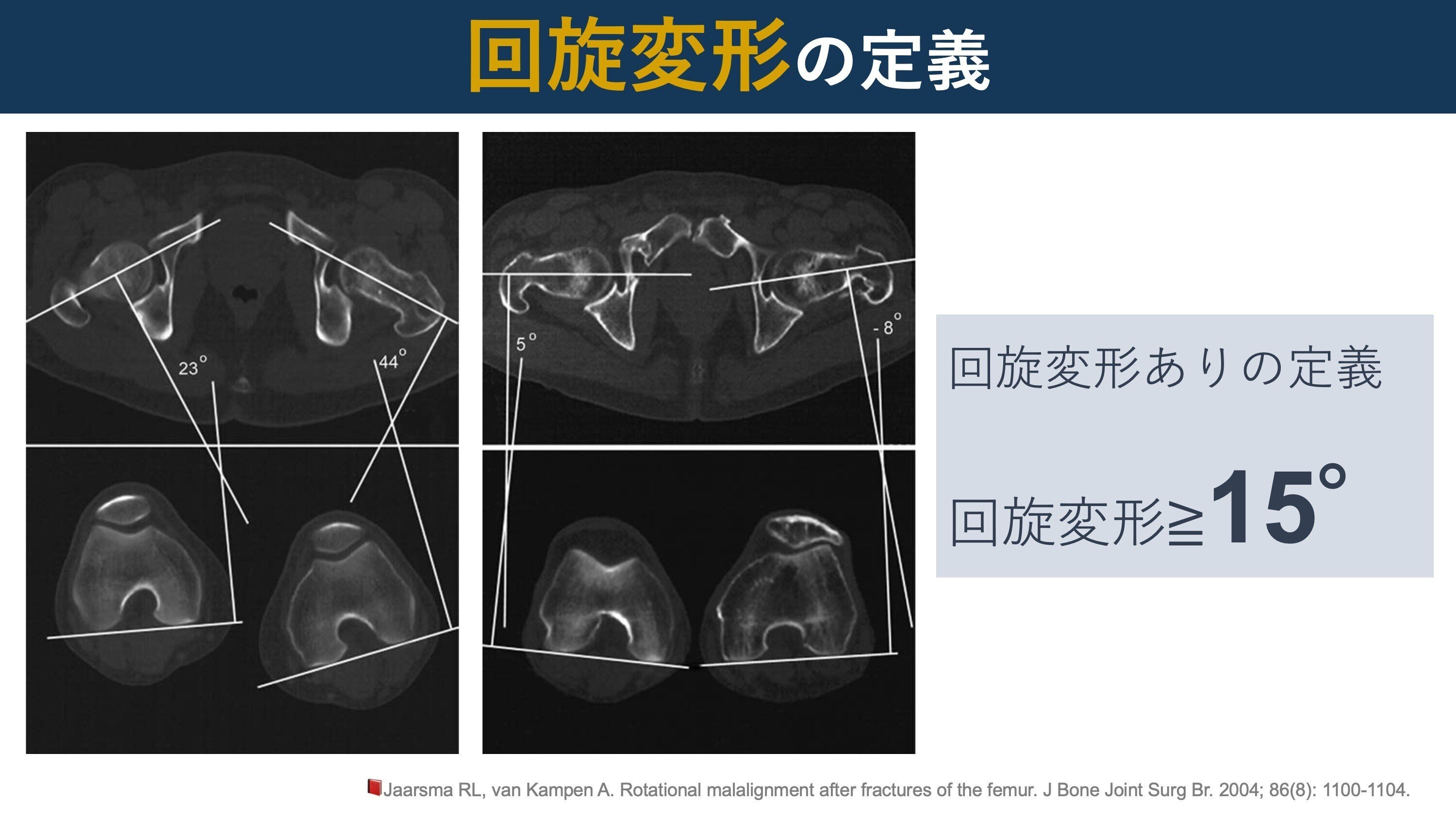 大腿骨近位部骨折後の下肢の短縮・回旋変形｜Super Human | 理学