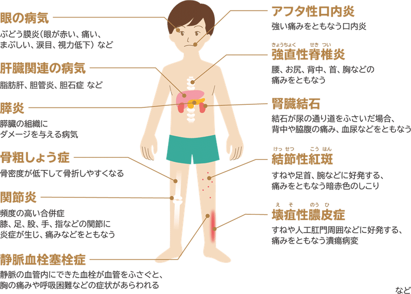 クローン病に罹患している場合、がんのリスクを下げる方法はありますか?
