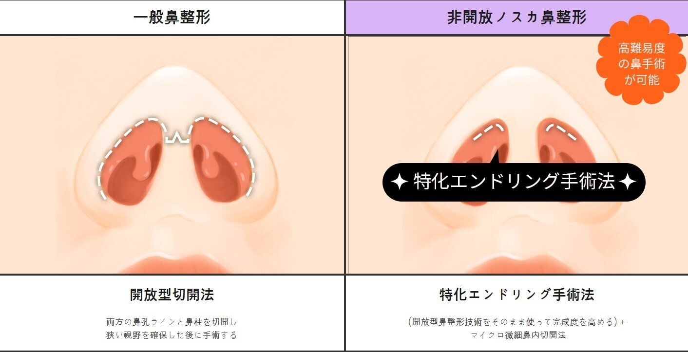 セロ美容外科 ＃ノスカ鼻整形｜セロ美容外科