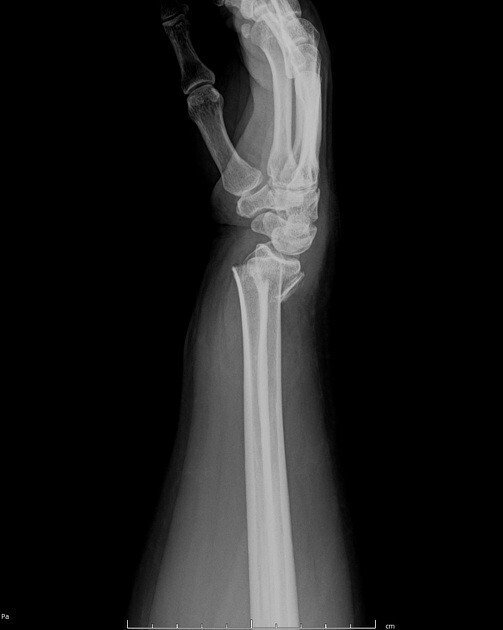 上肢の骨折特徴と合併症｜PTkokushi_taisaku