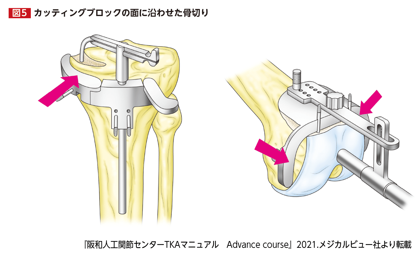 阪和人工関節センターTKAマニュアル Advanced