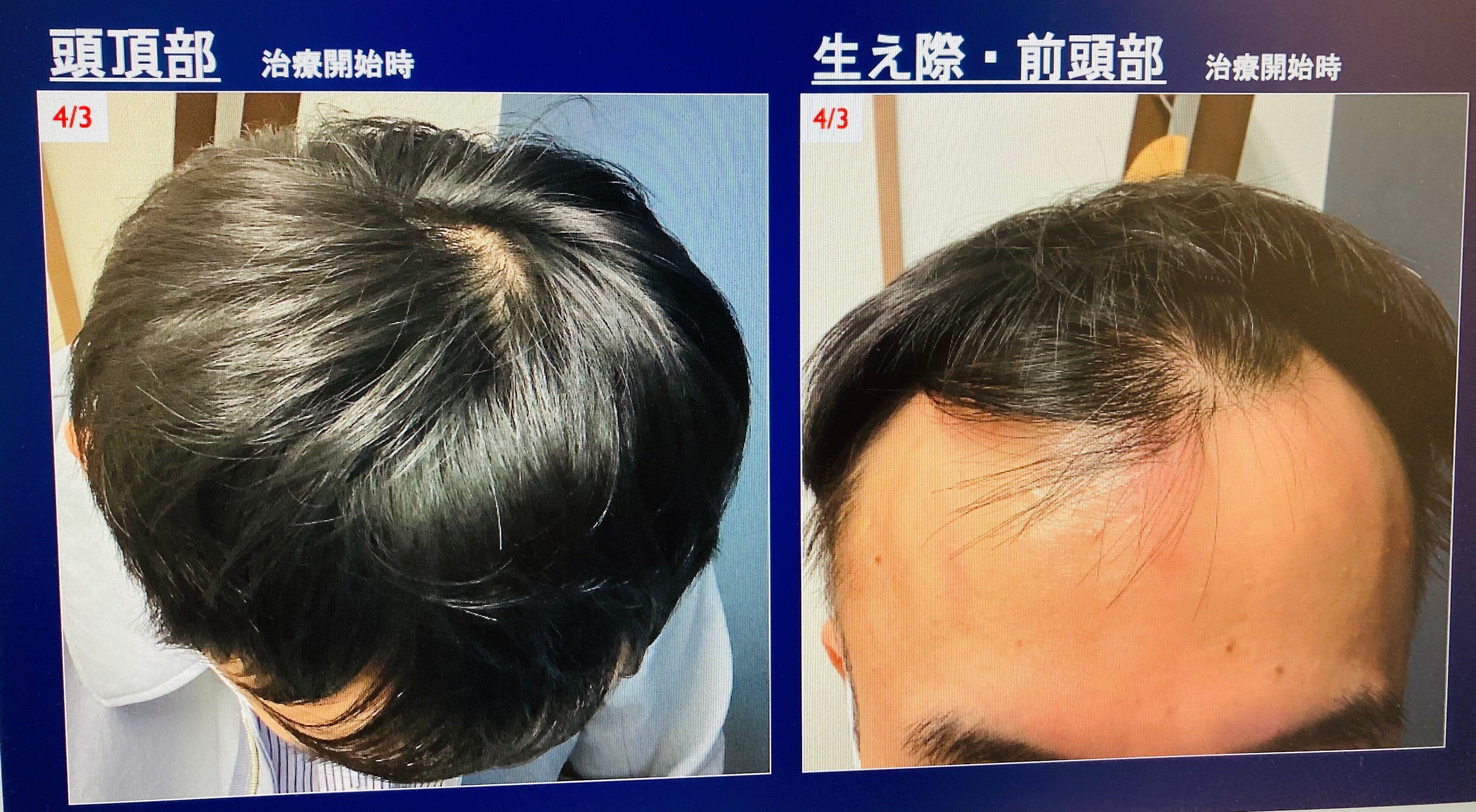 69 AGA治療7回目診察を終えて｜ジセおじ GAMI